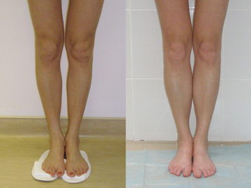 Кривые ноги исправление