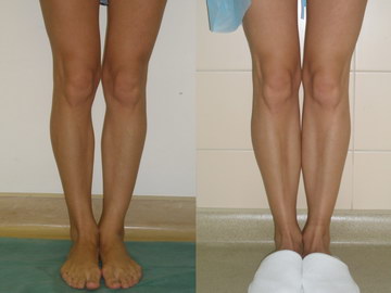 Кривые ноги исправление